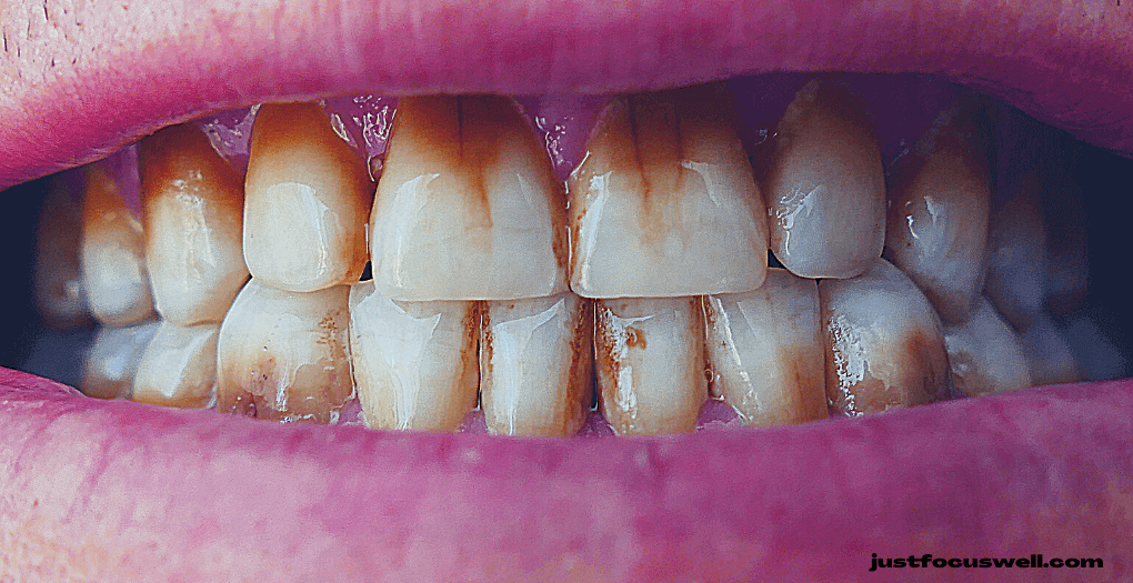 How To Protect Your Teeth From Discoloration?