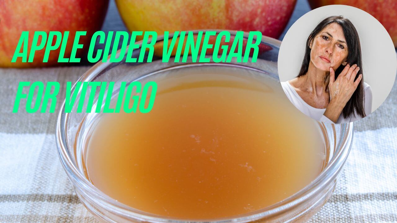 Apple Cider Vinegar for vitiligo
